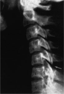 Phase 2 subluxation degeneration