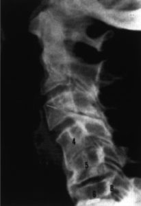 Phase 4 subluxation degeneration