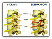 The Alarming Causes and Effects of Subluxation - Statera Chiropractic